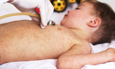 Child having a check-up | Measles Threat Set to Climb During the Holidays | Featured