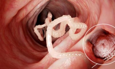 Tapeworm parasites | Tapeworm Removed from Mans Brain After Months of Headaches | Featured
