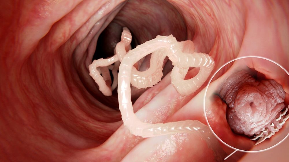Tapeworm parasites | Tapeworm Removed from Mans Brain After Months of Headaches | Featured